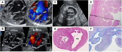 Low-frequency maternal novel MYH7 mosaicism mutation in recurrent fetal-onset severe left ventricular noncompaction: a case report